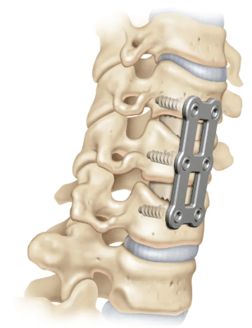 Dental Implant all on 4 blog 