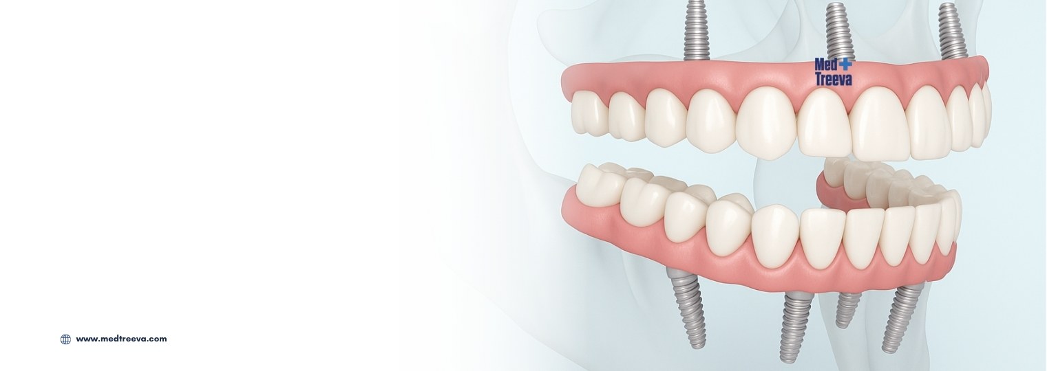 web_All-on-4 Dental Implants in India