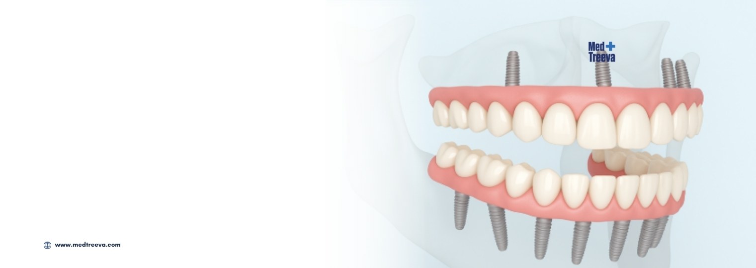web_All-on-6 Dental Implants in India