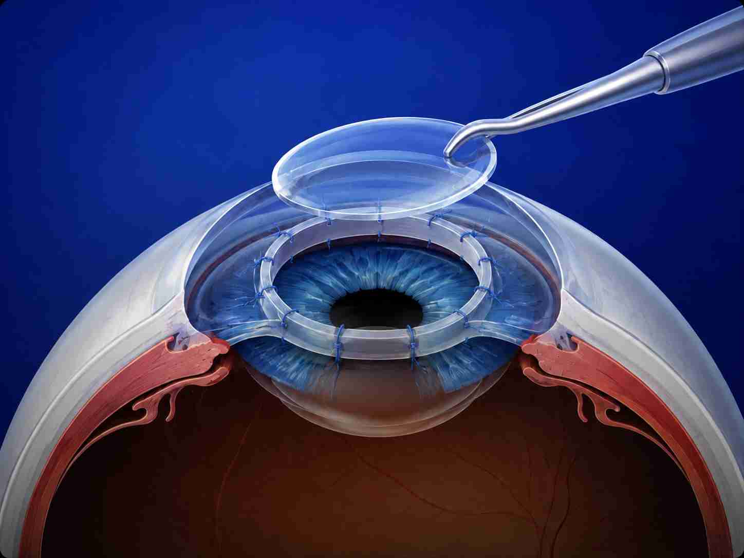 web_DALK Cornea Transplant