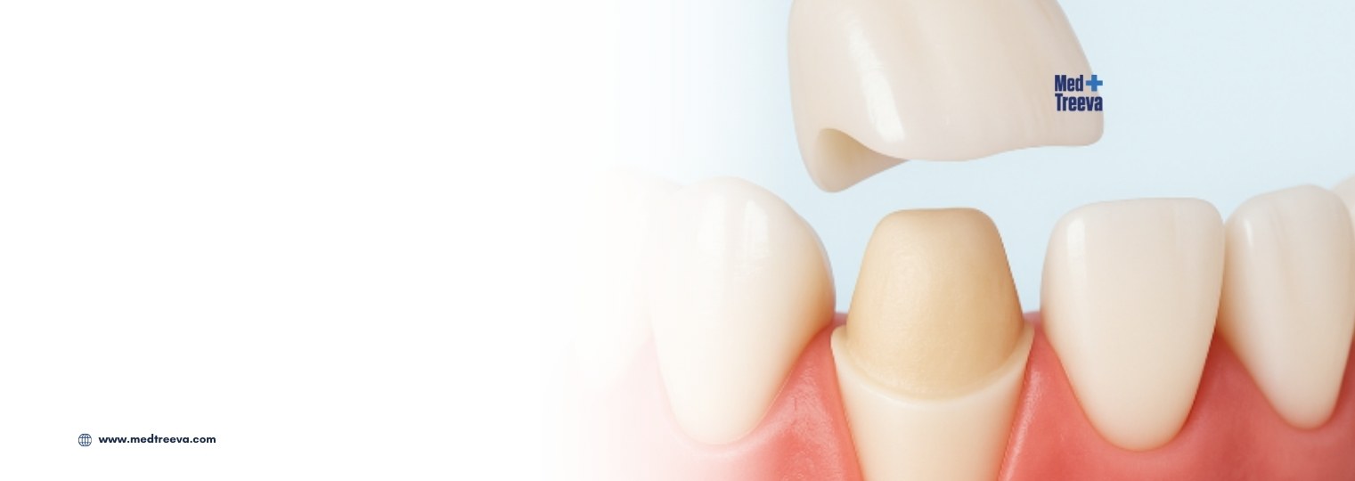 web_Dental Crowns & Veneers in India
