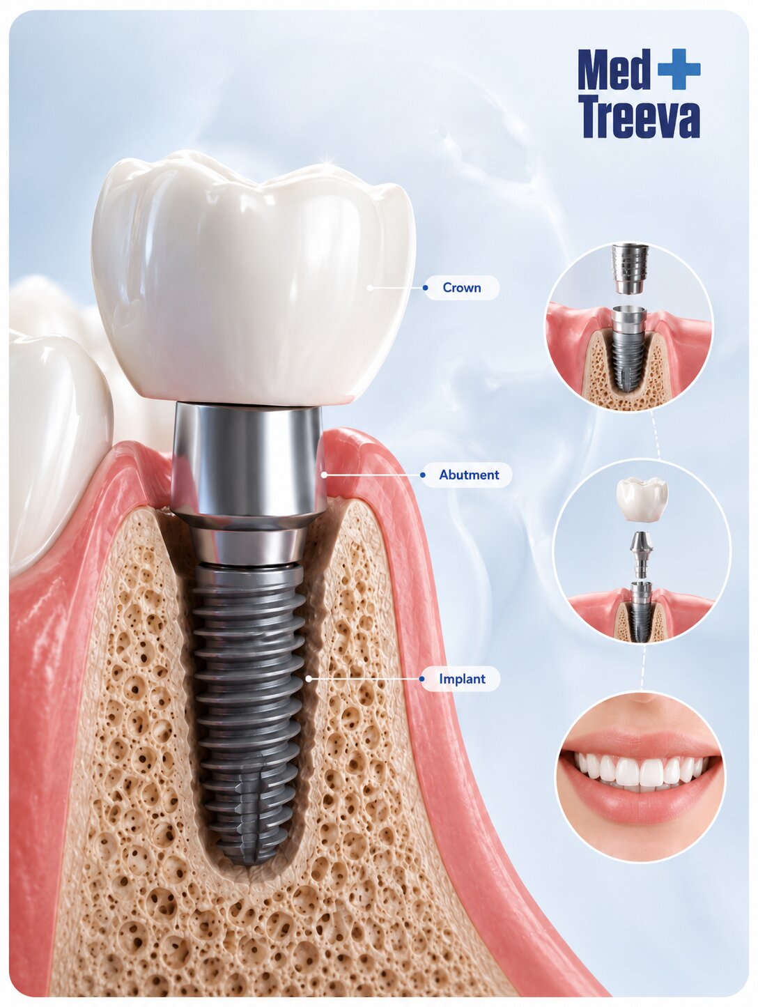 web_Step-by-Step All-on-6 Dental Implant Procedure