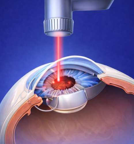 web_Femtosecond Laser Cataract Surgery