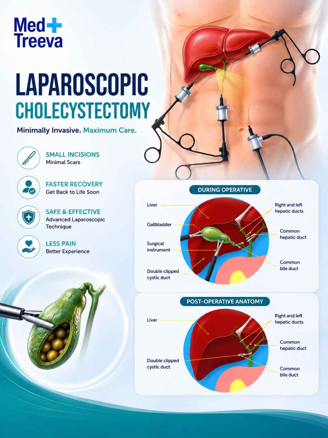 web_Gallbladder Stone Surgery in India