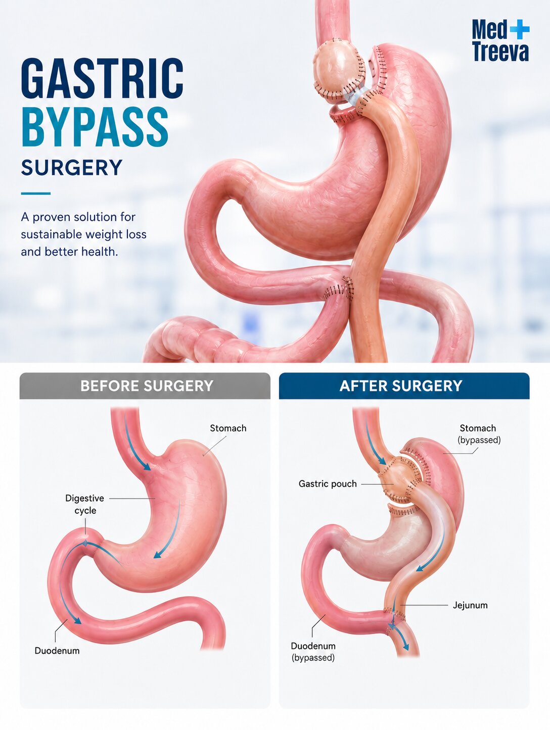 web_Gastric Bypass Surgery in India
