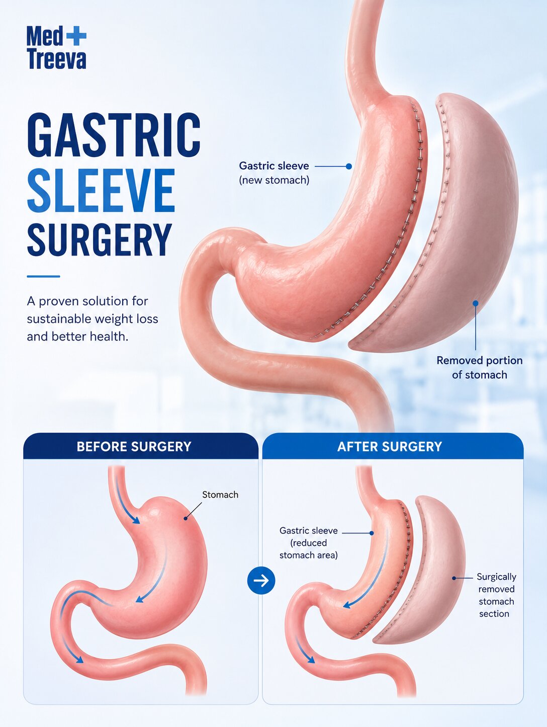 web_ Gastric Sleeve Surgery