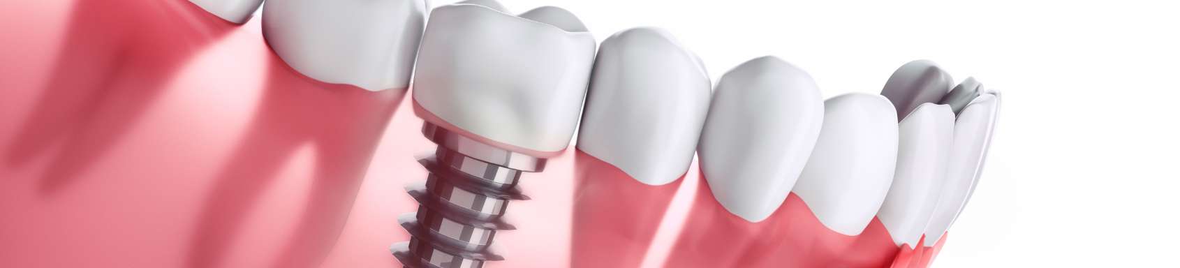 web_Get a Permanent Smile with All-on-4 Dental Implants in India