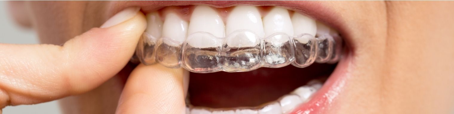 web_Get Clear Aligners and Invisible Braces in India