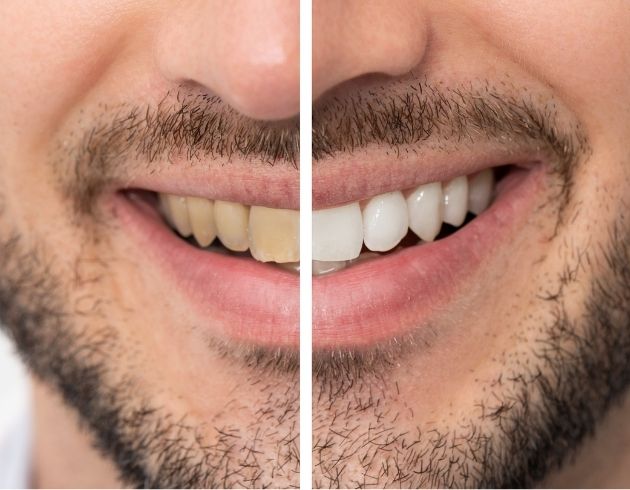 web_How Teeth Whitening Treatment Works