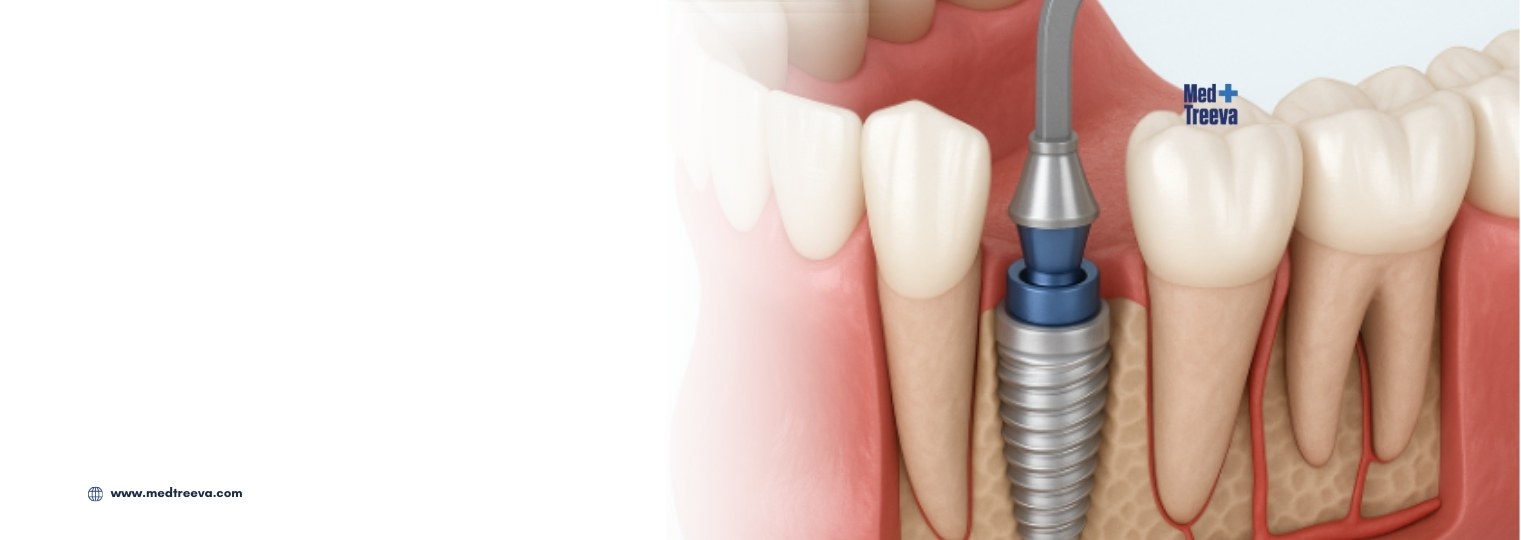 web_Immediate Dental Implants In India