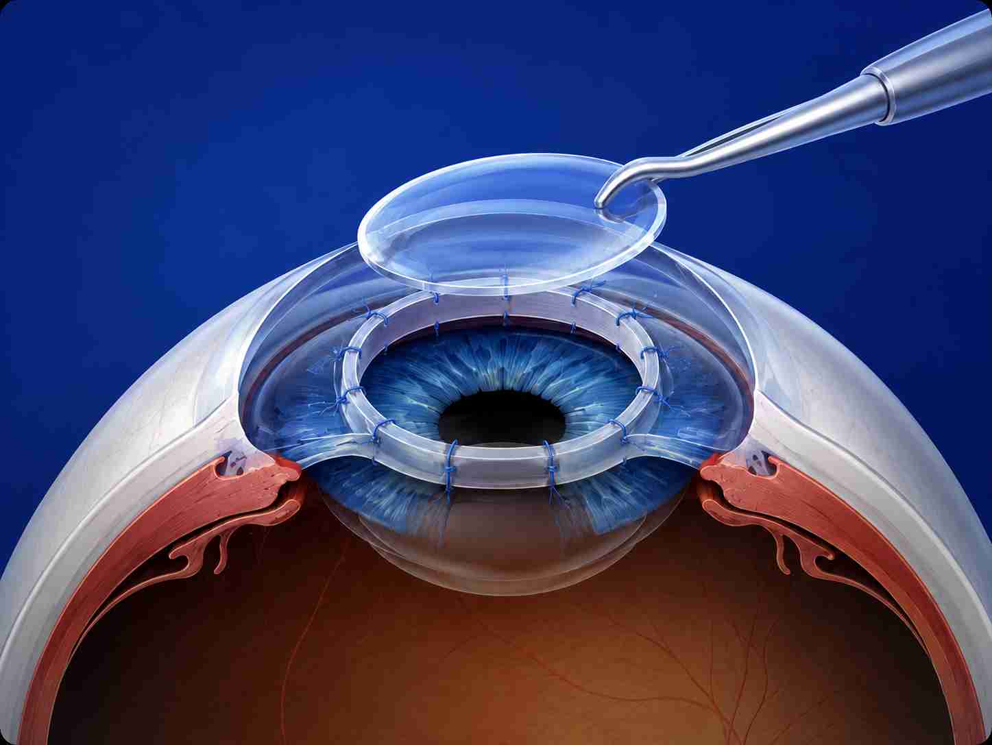 web_Penetrating Keratoplasty