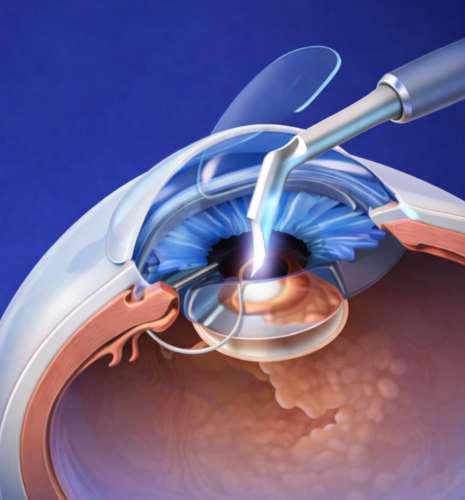 web_Phacoemulsification Surgery