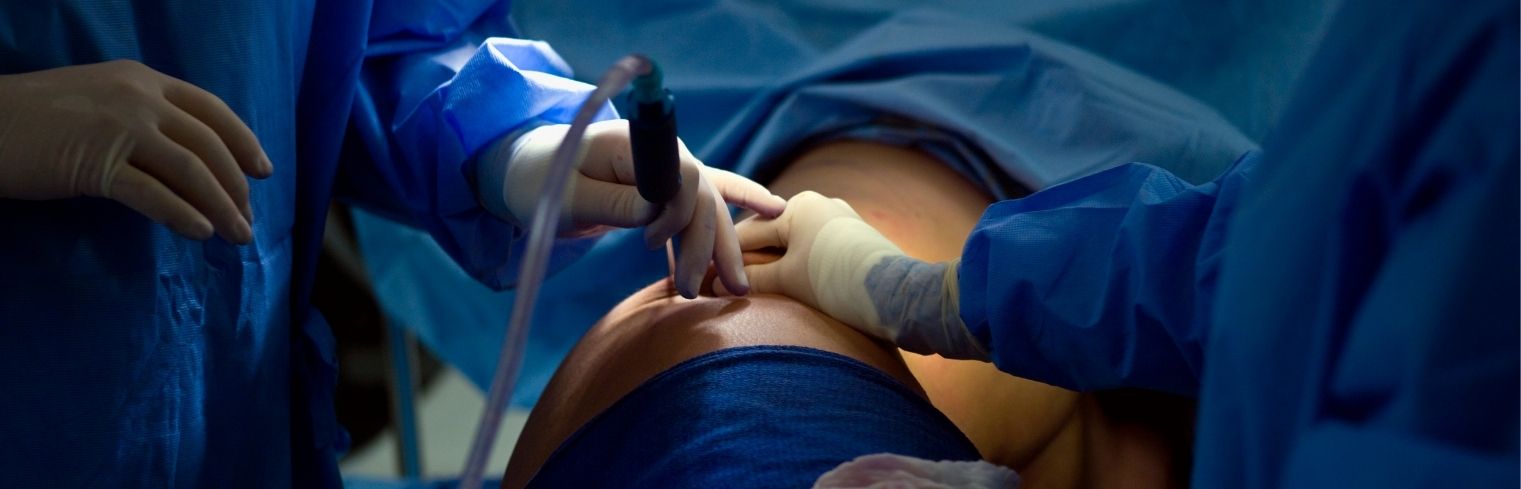 web_Shape Your Body with 360 Liposuction in India