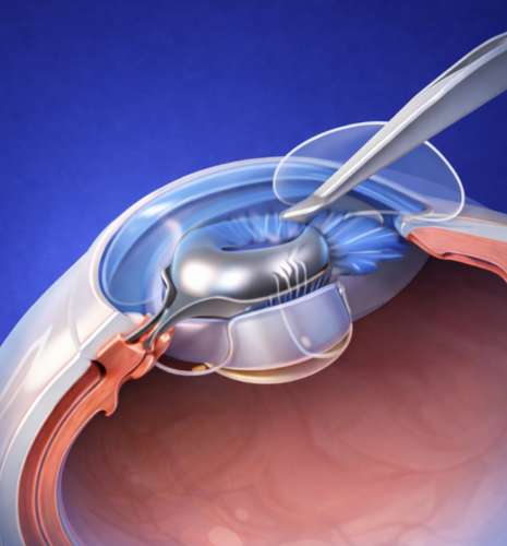 web_Small Incision Cataract Surgery (MSICS)