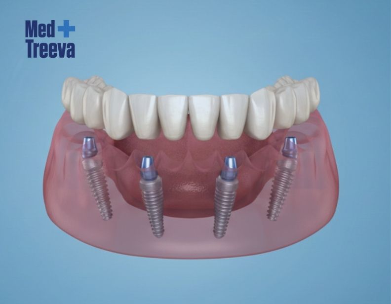 web_Step-by-Step All-on-4 Dental Implant Procedure