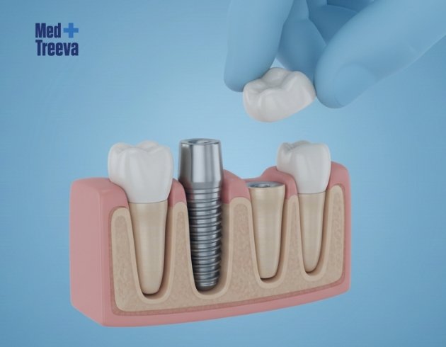 web_Step-by-Step All-on-6 Dental Implant Procedure