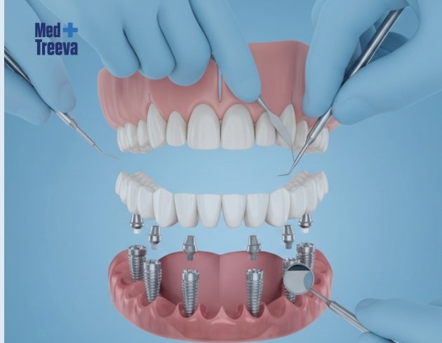 web_Step-by-Step All-on-6 Dental Implant Procedure