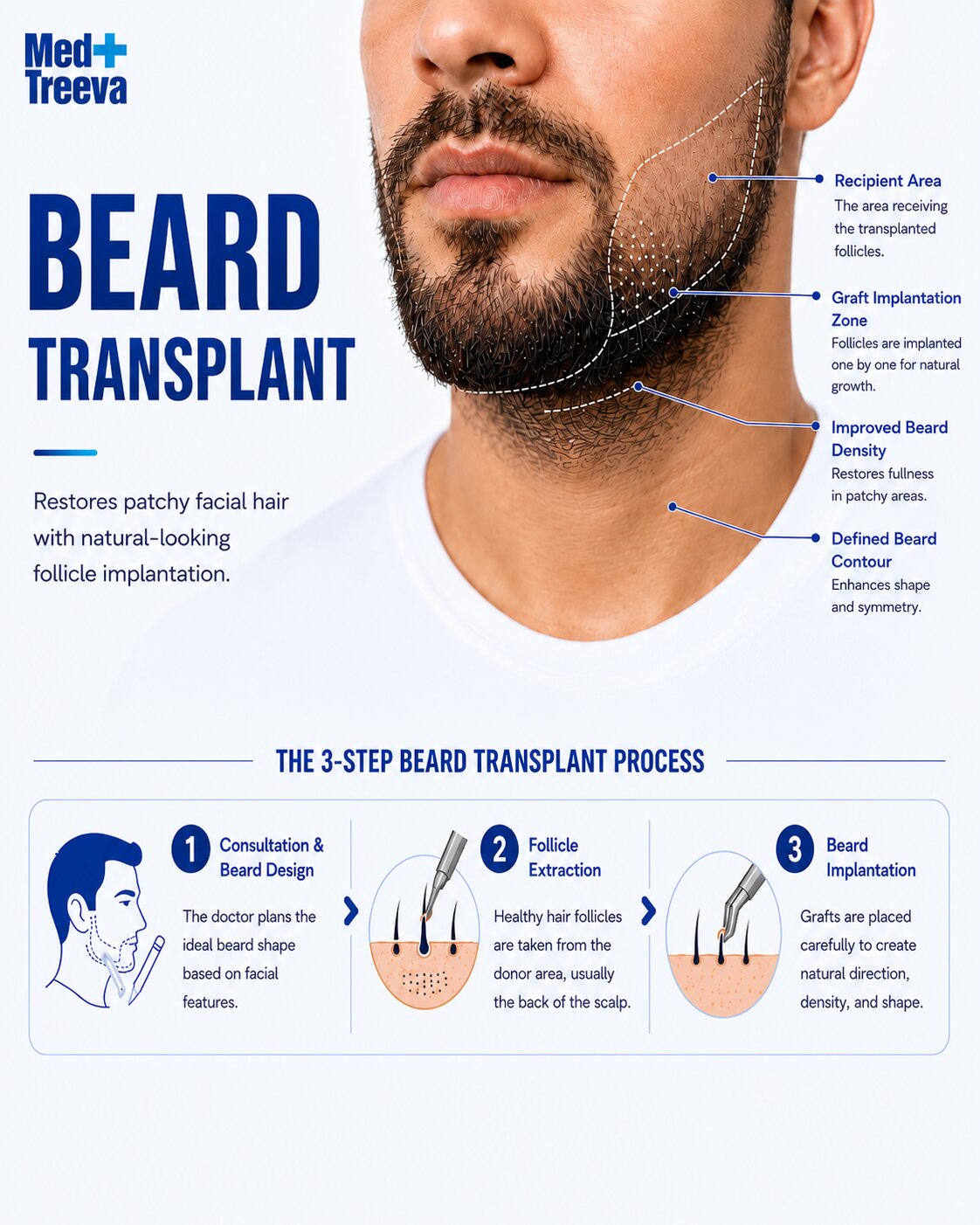 web_Step-by-Step Beard Transplant Procedure