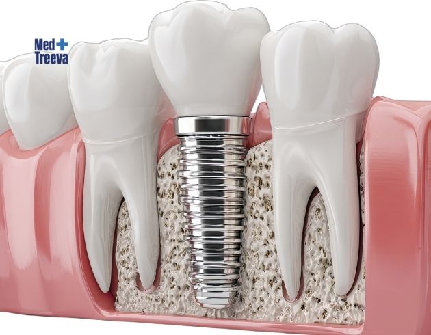 web_Step-by-Step Immediate Smile Restoration