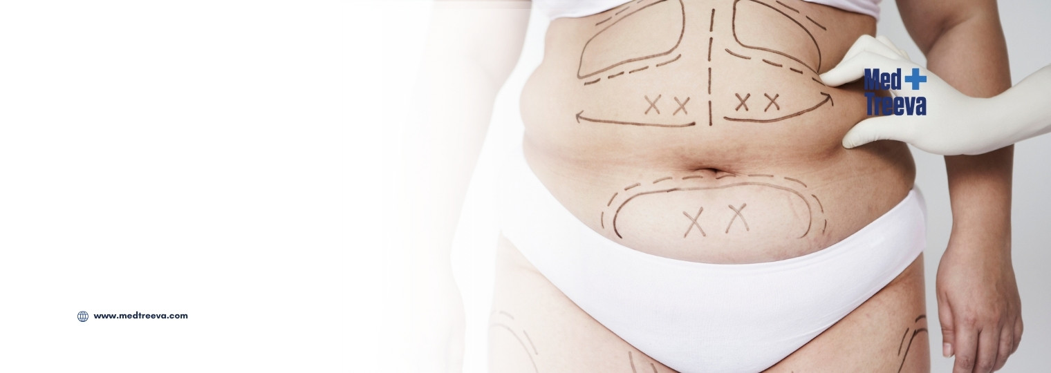 web_Tummy Tuck (Abdominoplasty) in India