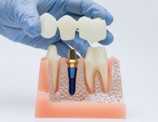 web_Step-by-Step All-on-6 Dental Implant Procedure