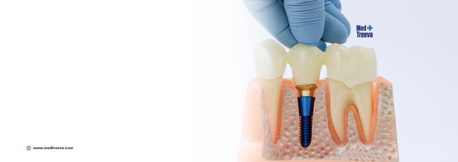 web_Types of Dental Implants in India
