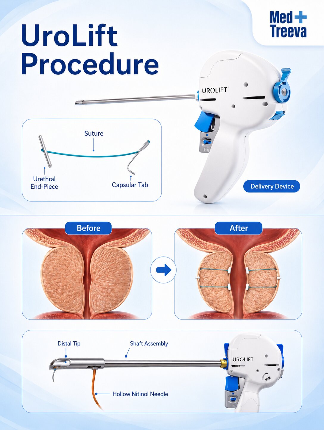 web_UroLift Procedure