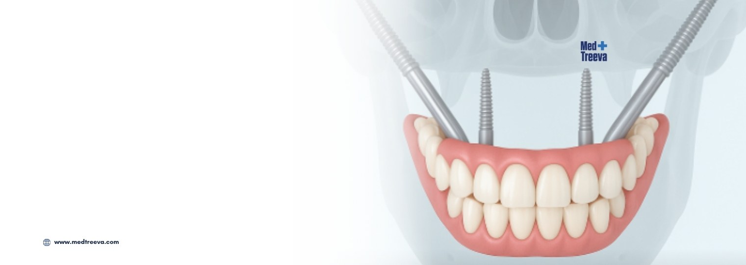 web_Zygomatic Implant in India