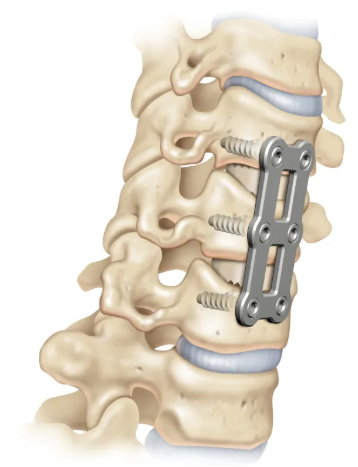 Dental Implant all on 4 blog 