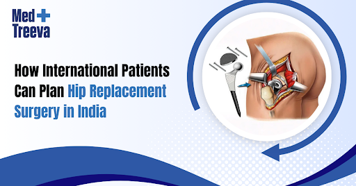 Plan Hip Replacement Surgery in India for Global Patients