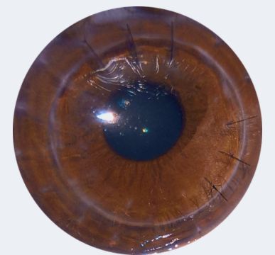 All-Inclusive Corneal Transplant Package in India