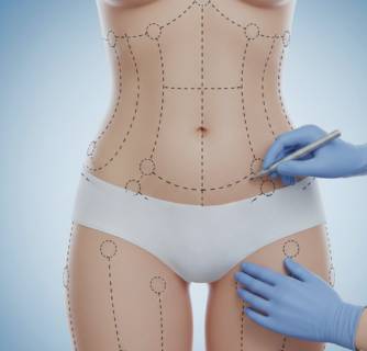 360 Liposuction in India
