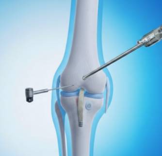 ACL Reconstruction Surgery in India