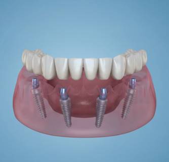 All-on-4 Dental Implants in India