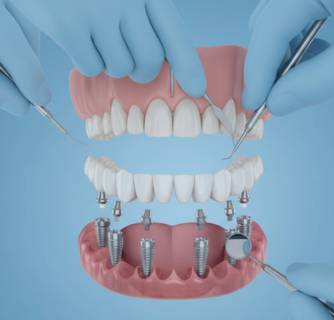 All-on-6 Dental Implants in India