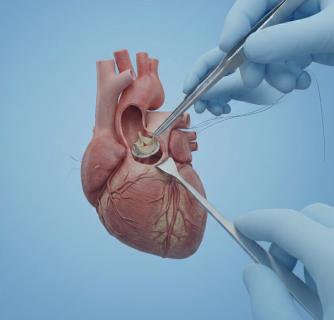 Aortic Valve Replacement and Repair in India