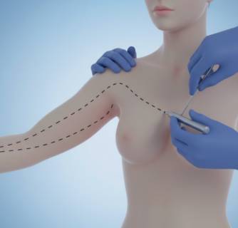 Arm Lift Surgery in India