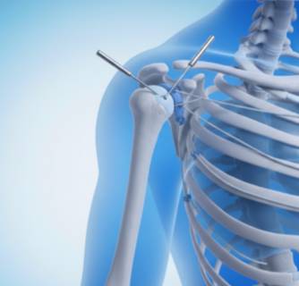 Arthroscopic Rotator Cuff Repair Surgery in India