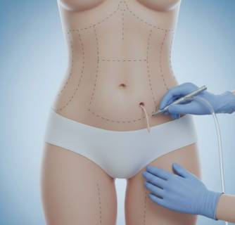 Best Liposuction in India