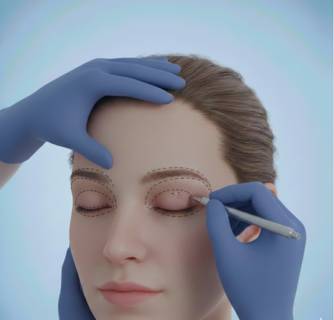 Blepharoplasty in India
