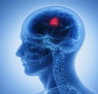 Brain Tumor Treatment in India