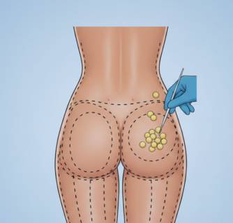 Brazilian Butt Lift in India
