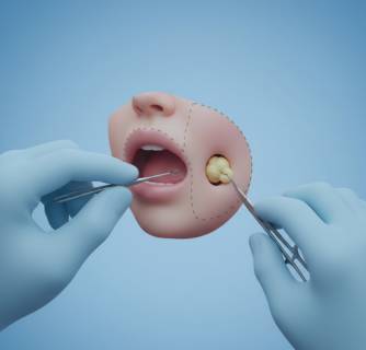 Buccal Fat Removal in India
