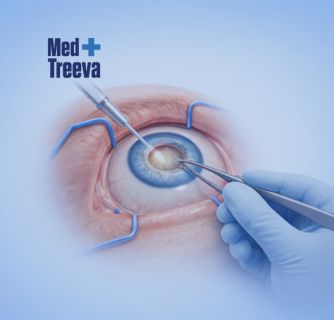 Cataract Surgery in India