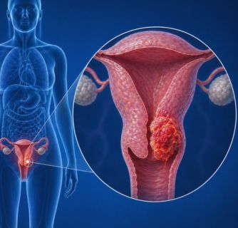 Cervical Cancer Treatment in India