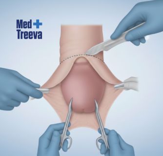 Circumcision Surgery in India