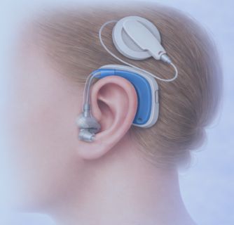 Cochlear Implant in India