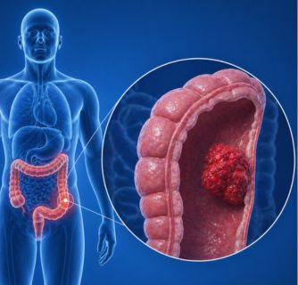 Colon Cancer Treatment in India