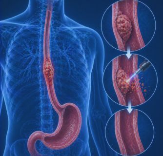 Esophageal Cancer Treatment in India