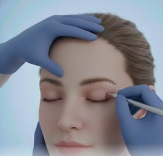Eyebrow Transplant in India